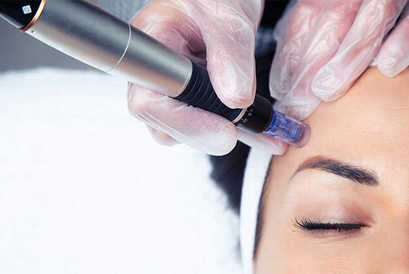Mesotherapy injections to forehead