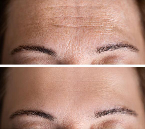 Before and after of wrinkle treatment on forehead